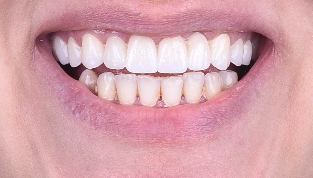 نتيجة الفينير في Dentaland Premium Luxury Clinic & Academy – تحول ابتسامة الأسنان العلوية