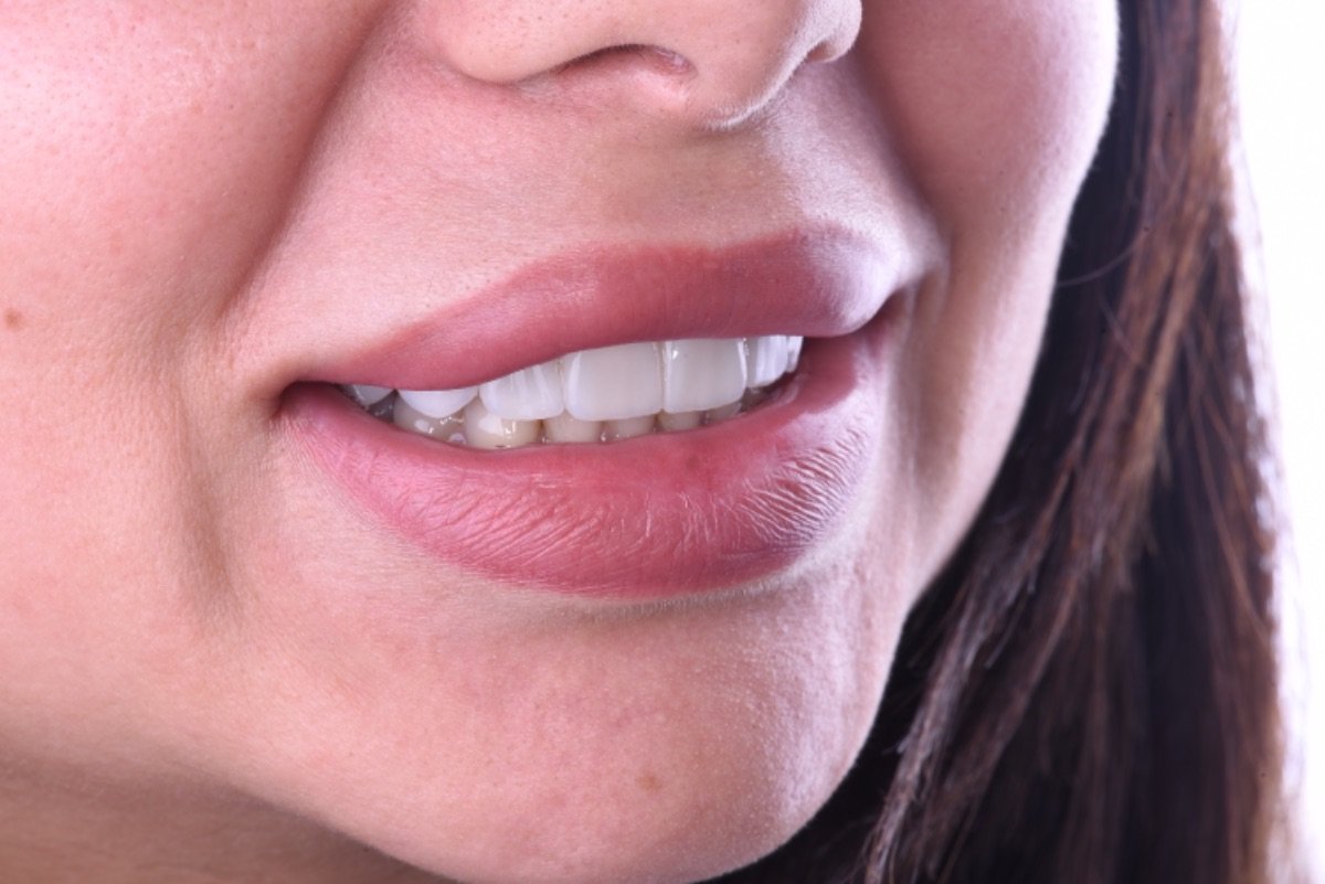 نتيجة ابتسامة الفينير في Dentaland Premium Luxury Clinic & Academy، أسنان بيضاء طبيعية