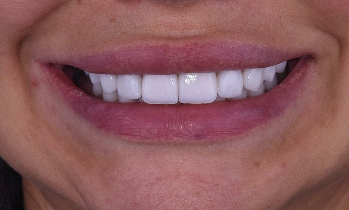 نتيجة ابتسامة الفينير في Dentaland Premium Luxury Clinic & Academy، أسنان بيضاء ناصعة