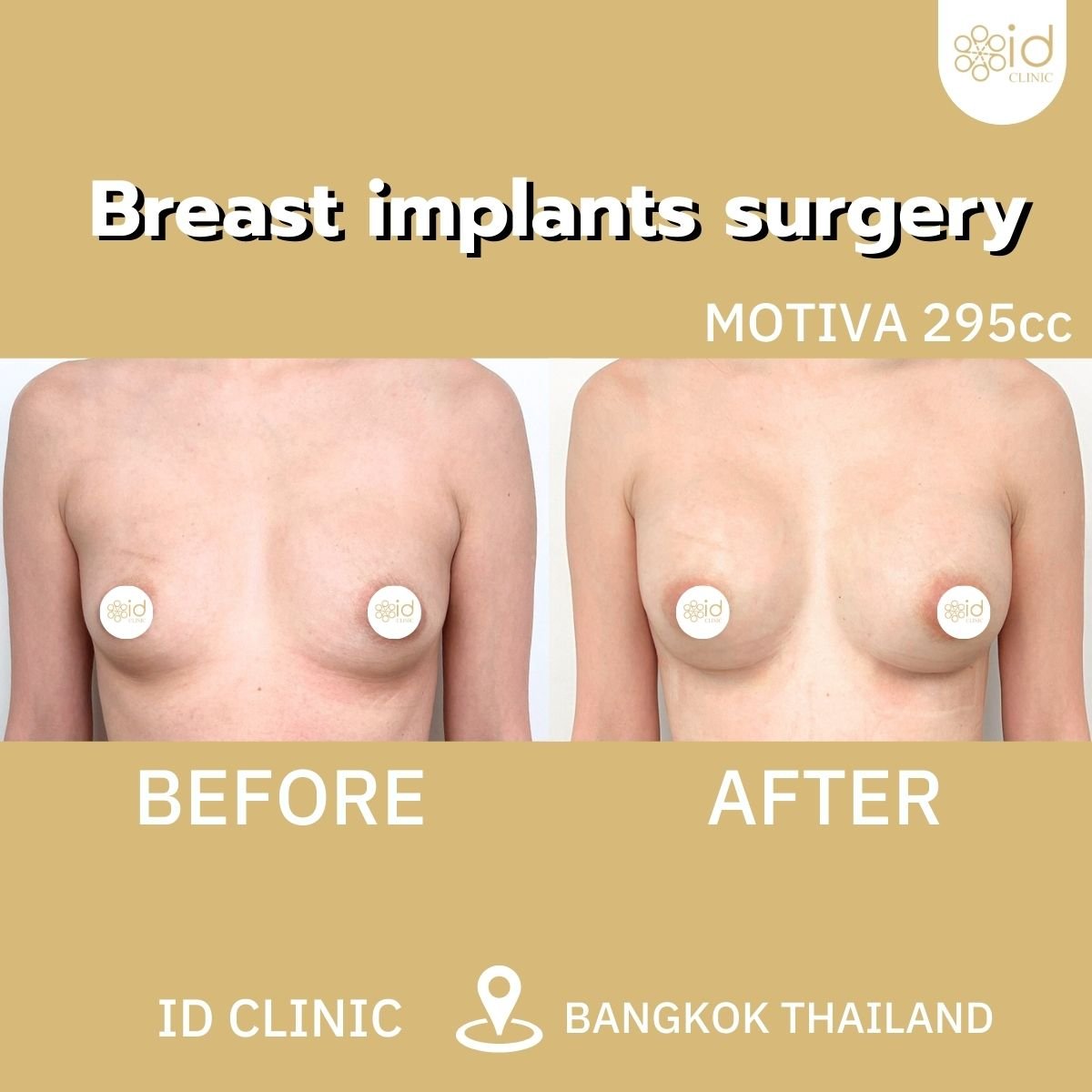 نتائج تكبير الثدي قبل وبعد في ID Clinic Bangkok باستخدام حشوات Motiva 295cc