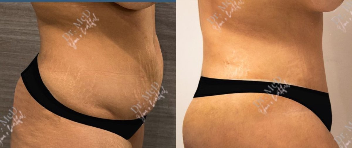 Resultados de liposucción antes y después en Dr. MED – abdomen más plano y mejor contorno
