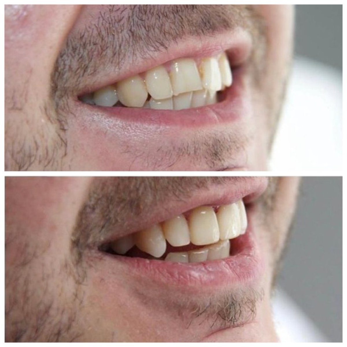 Before and after porcelain veneer results at TH Dental Clinic, improved smile aesthetics