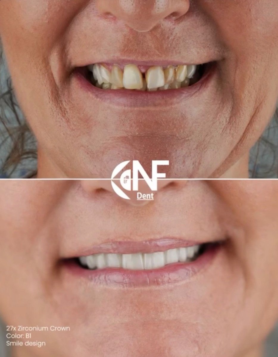 نتائج قبل وبعد تيجان الزركونيوم في Nifa Dent International – ابتسامة محسنة