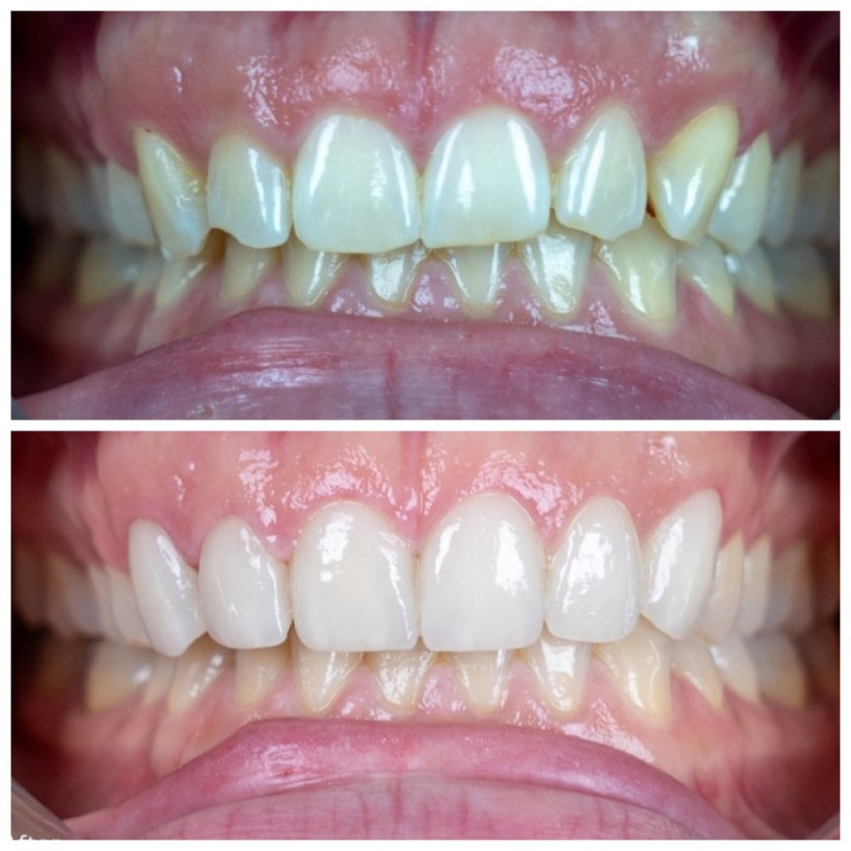 نتائج قبل وبعد قشور البورسلين في عيادة TH Dental Clinic – تحسين جمالية الابتسامة