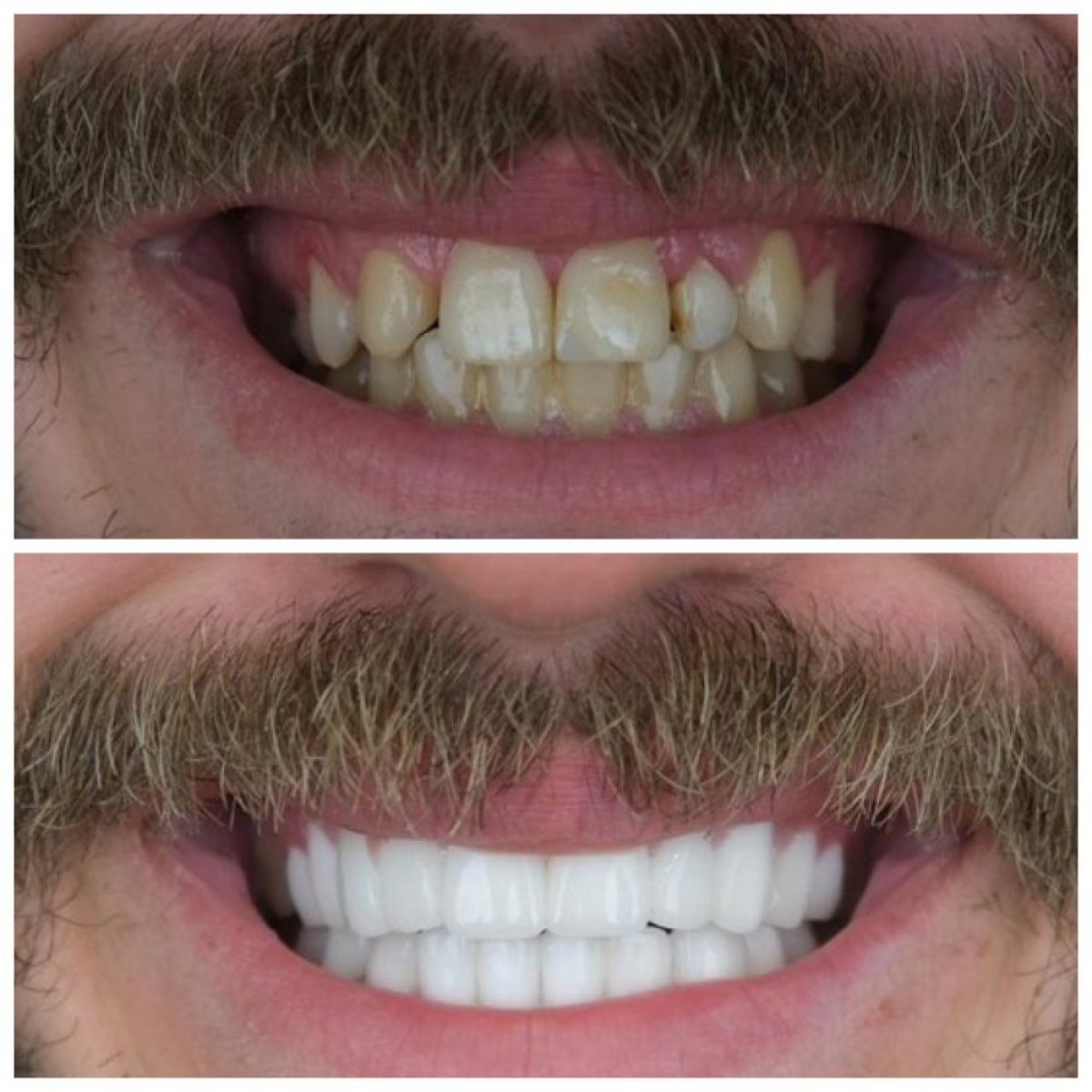 Resultados de antes y después de smile makeover en TH Dental Clinic: alineación y color mejorados