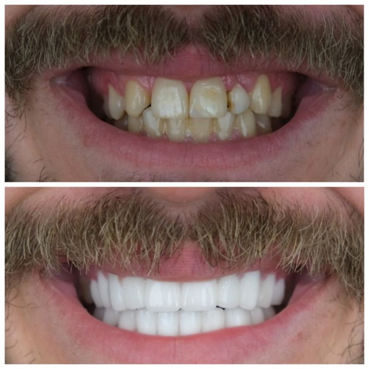 Resultados antes y después de coronas de zirconia en TH Dental Clinic – transformación de sonrisa
