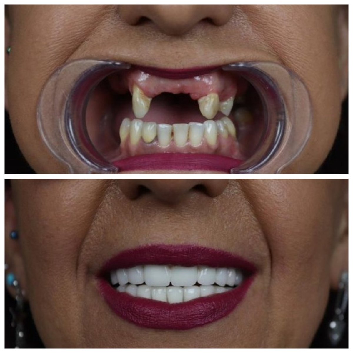 Resultados antes y después de coronas de zirconia en TH Dental Clinic, restauración de sonrisa