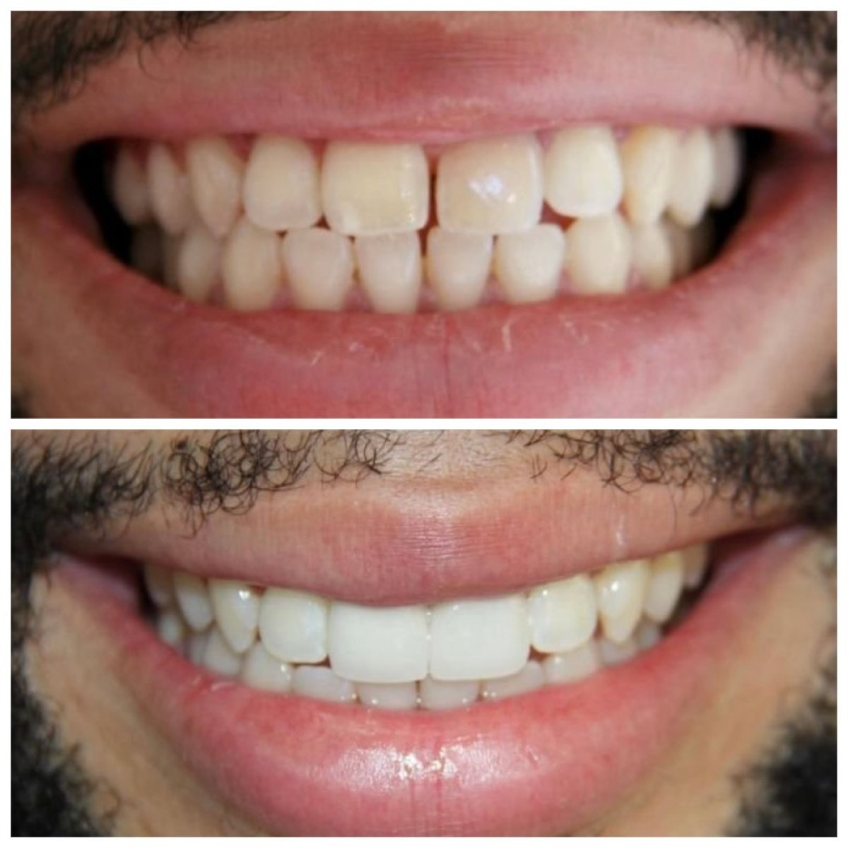 Resultados antes y después de coronas de zirconia en TH Dental Clinic – sonrisa mejorada