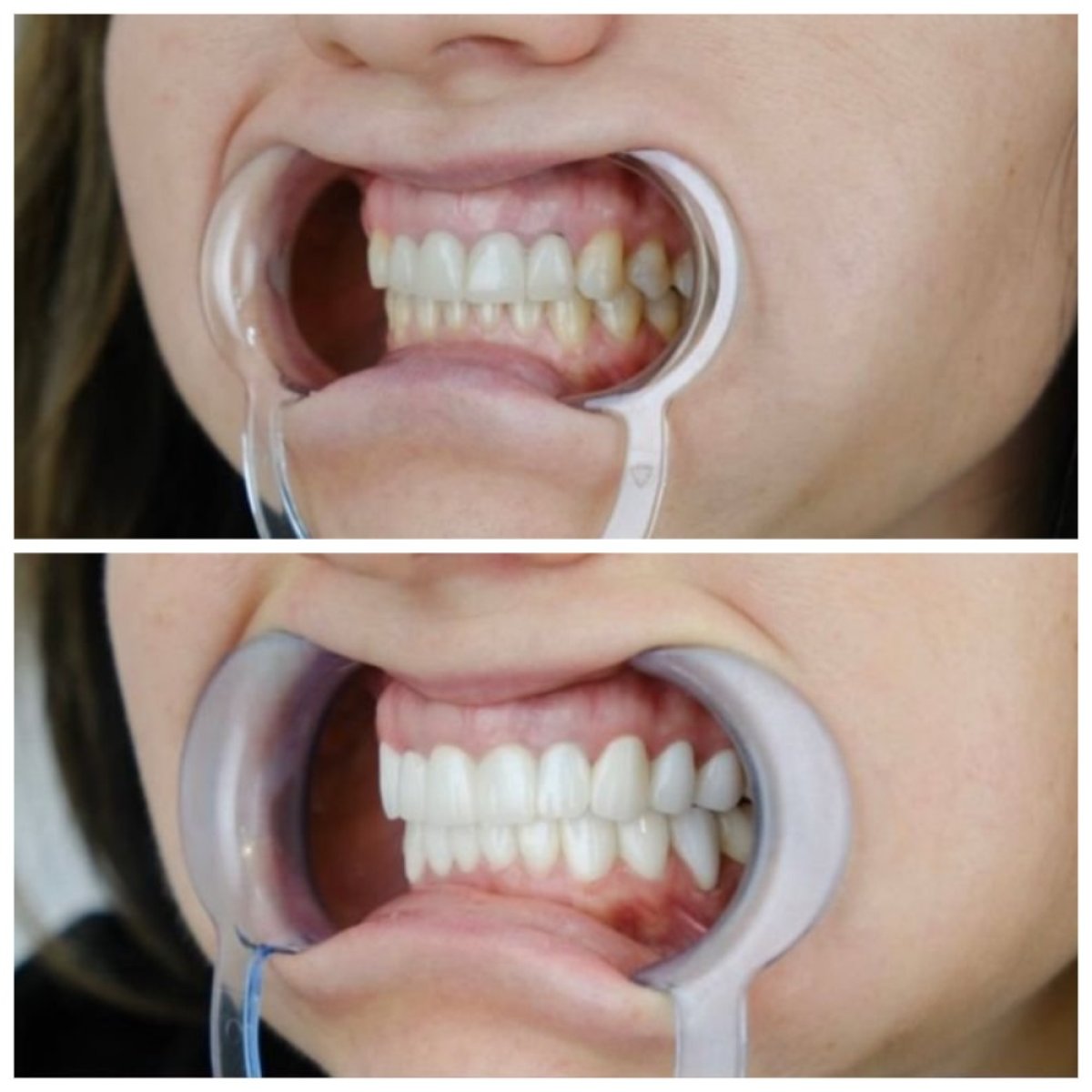 Resultados antes y después de coronas de zirconio en TH Dental Clinic, sonrisa mejorada