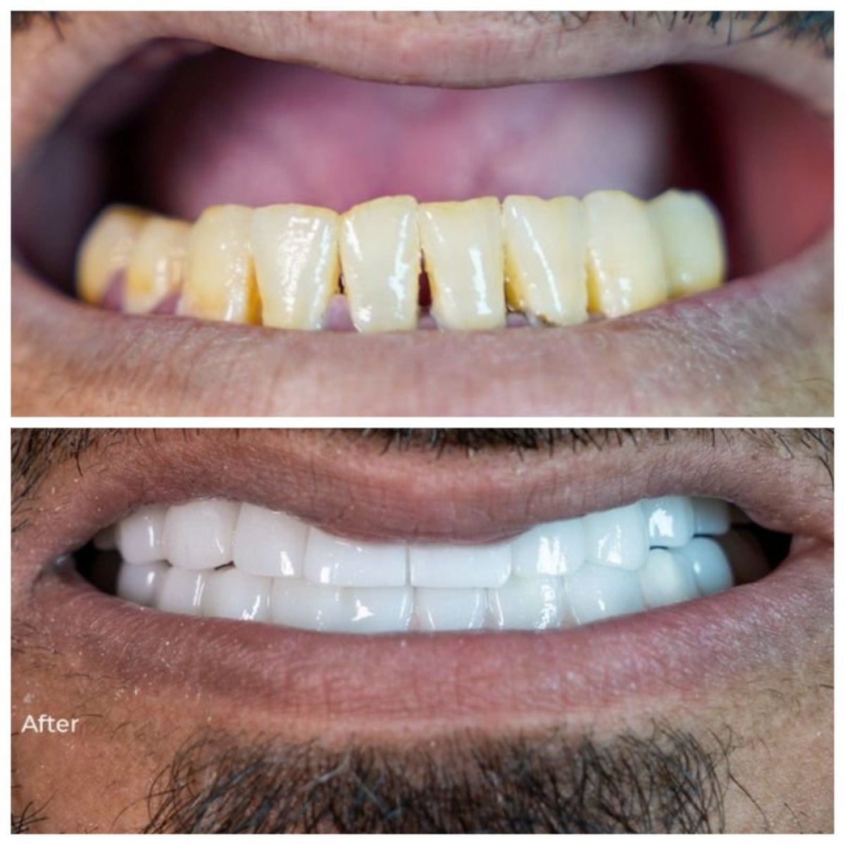 Resultados antes y después de implantes dentales en TH Dental Clinic – sonrisa blanca restaurada
