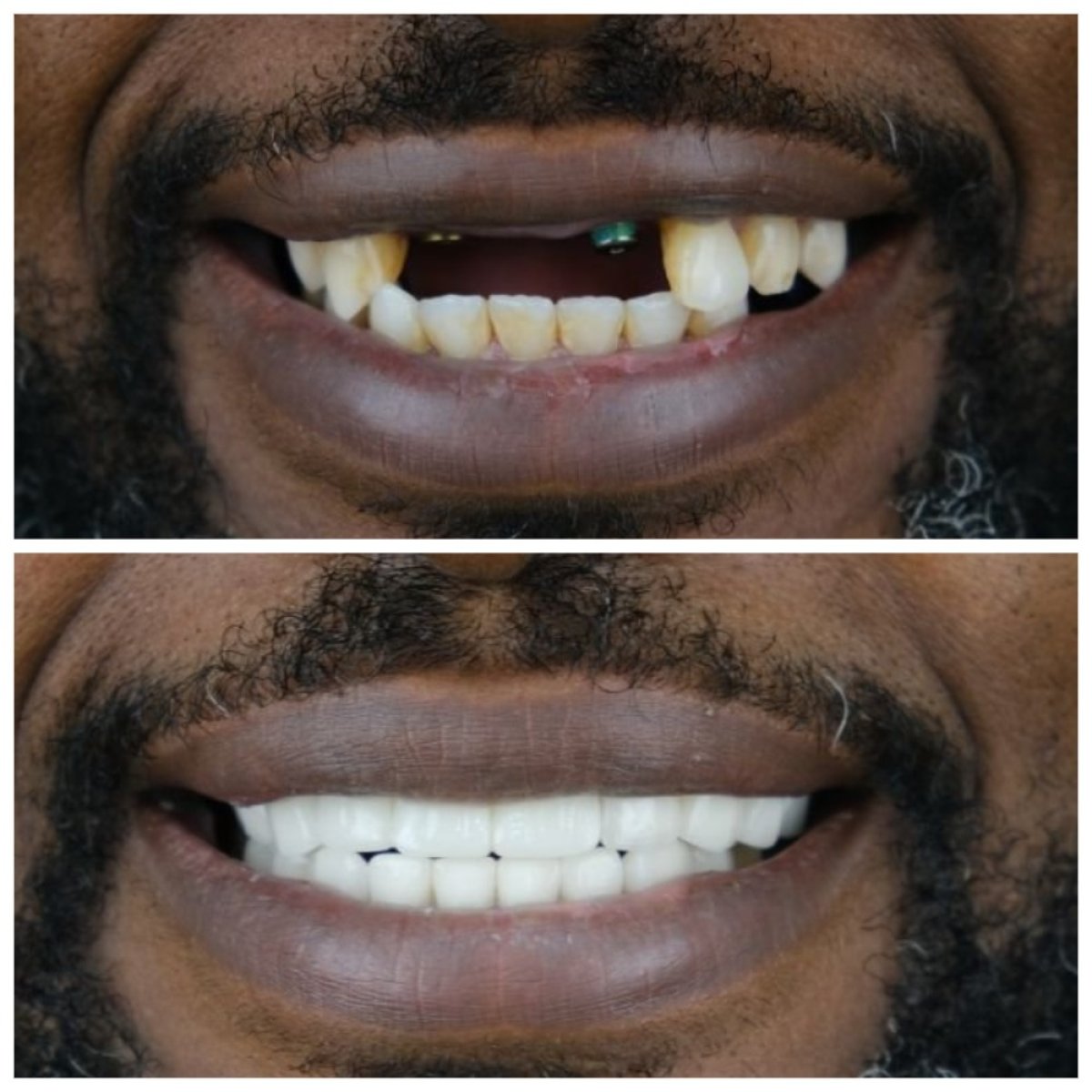 نتائج زراعة الأسنان قبل وبعد في TH Dental Clinic – استعادة الابتسامة ومحاذاة الأسنان