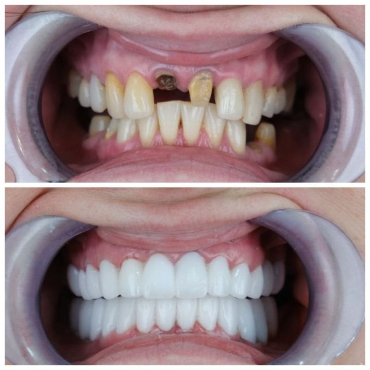 نتائج قبل وبعد زراعة الأسنان في عيادة TH Dental Clinic – استعادة الابتسامة الكاملة