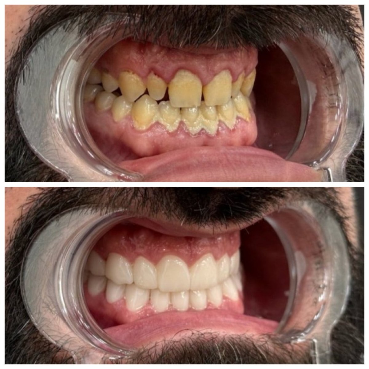 نتائج قبل وبعد ابتسامة هوليود في عيادة TH Dental Clinic – تجميل الابتسامة بالفينير