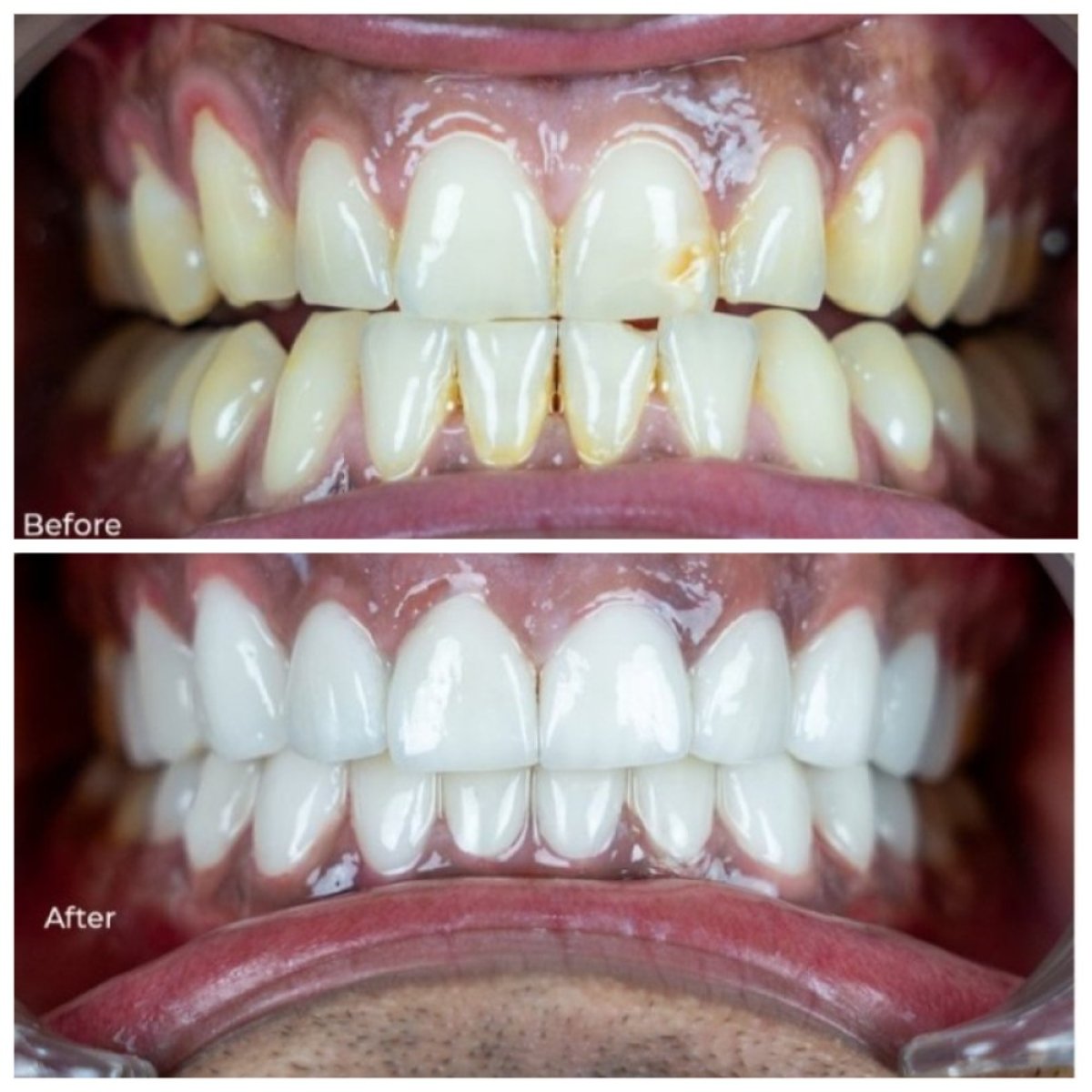 Resultados antes y después de Hollywood Smile en TH Dental Clinic: dientes más blancos y parejos