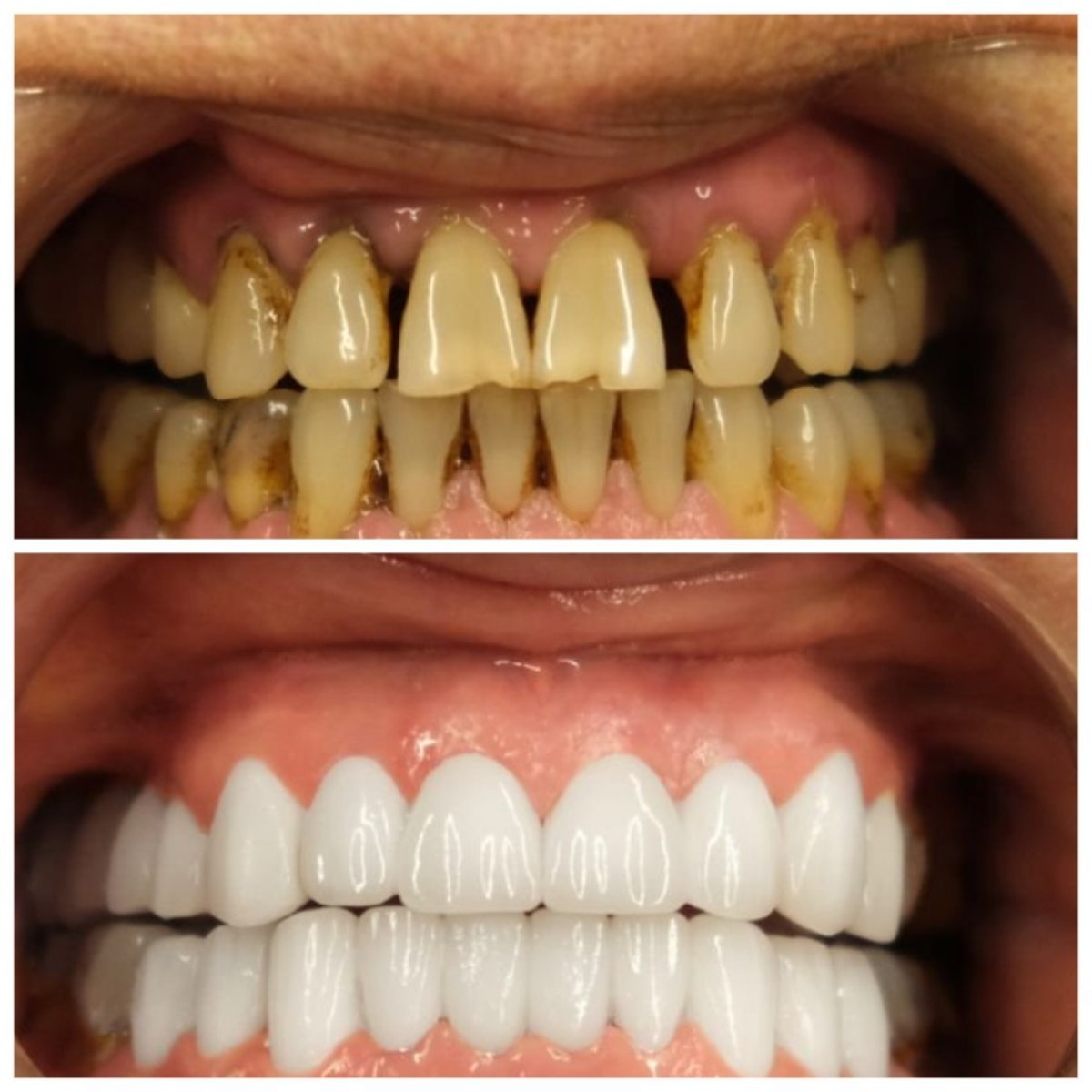 نتائج قبل وبعد ابتسامة هوليود في عيادة TH Dental Clinic – تحول ملحوظ للابتسامة