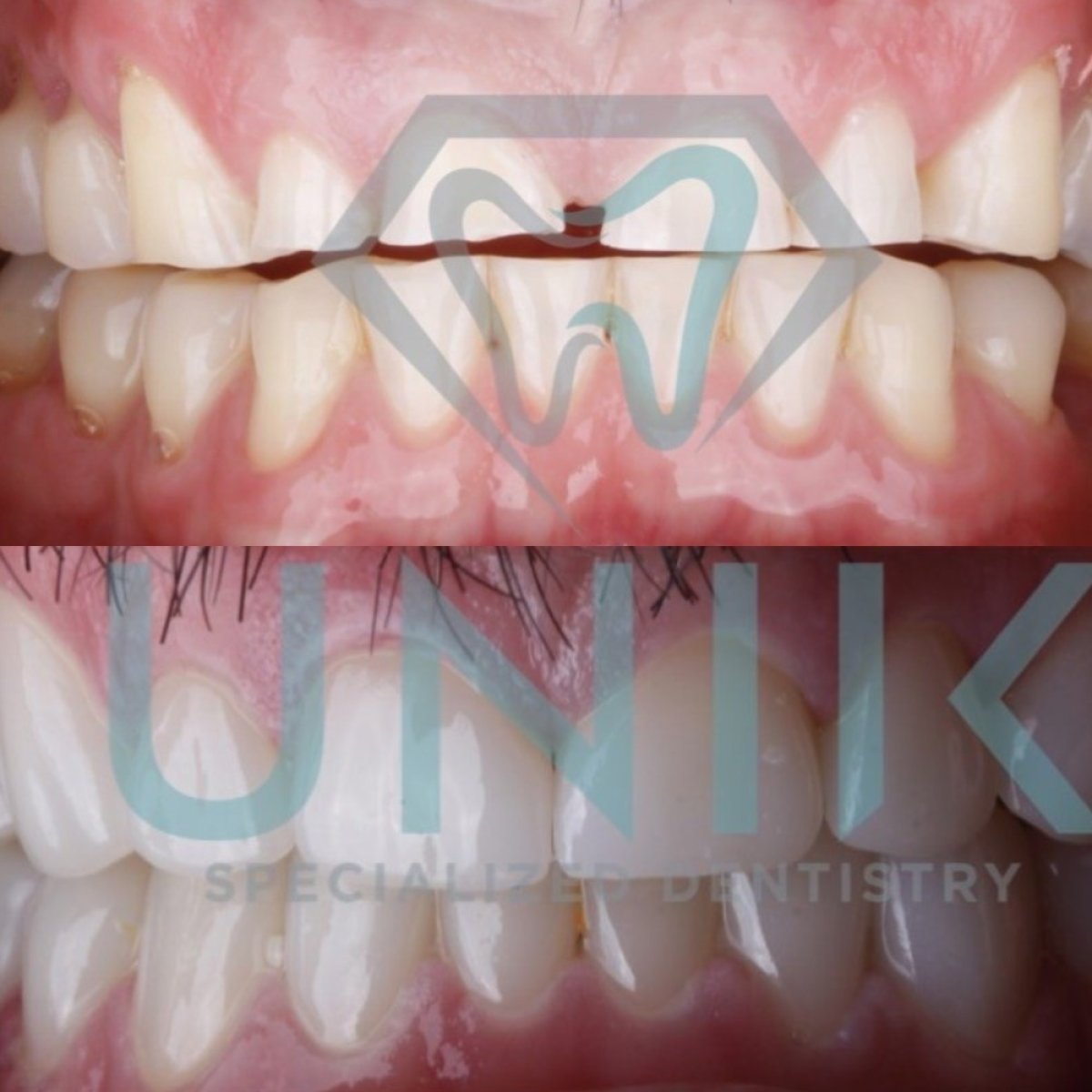 نتائج قبل وبعد تجميل الابتسامة في Unik Specialized Dentistry – تحسين محاذاة الأسنان