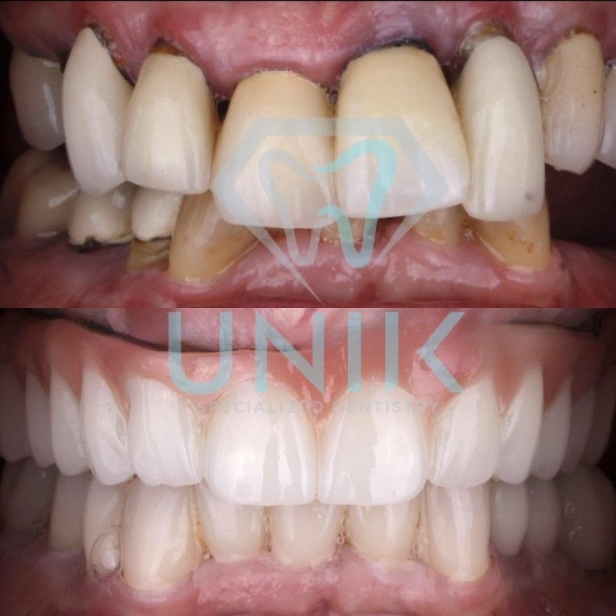 Before and after implant bridge results at Unik Specialized Dentistry, restored natural smile