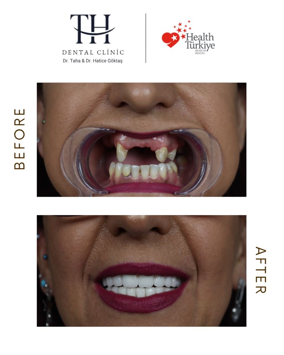 Resultado antes y después de implantes dentales All-on-6 en TH Dental Clinic, sonrisa restaurada