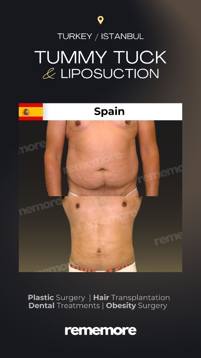 Resultados de abdominoplastia y liposucción antes y después en Memorial Şişli Hospital, abdomen plano