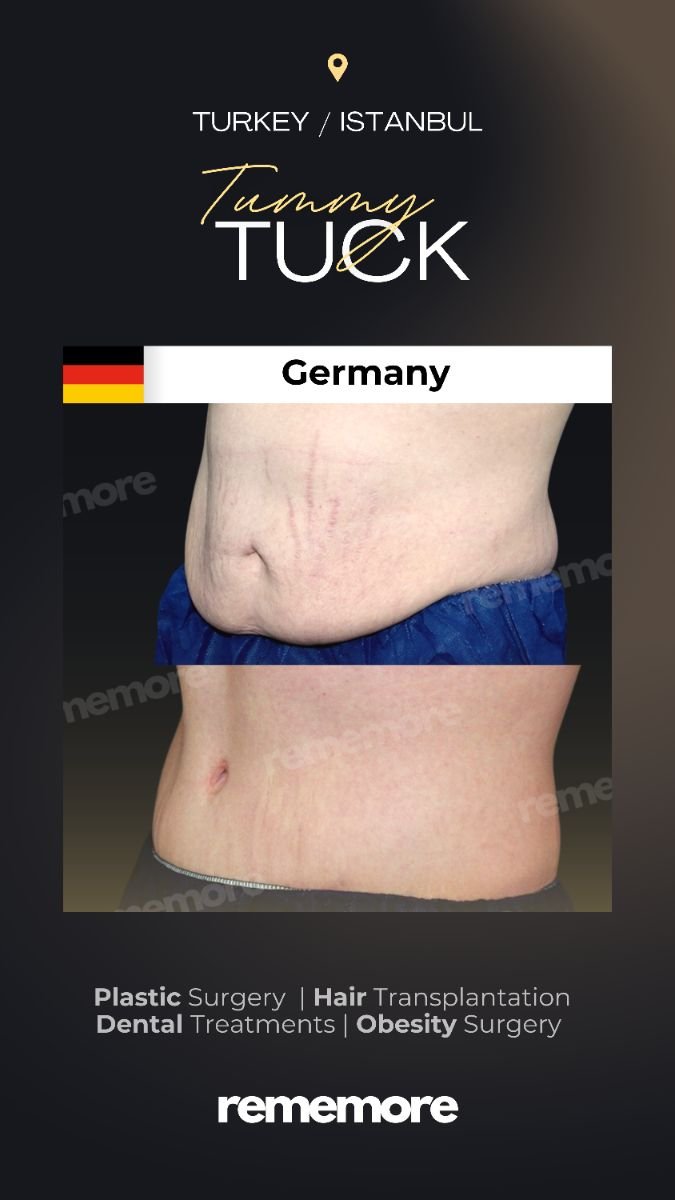 Resultados de abdominoplastia antes y después en Memorial Şişli Hospital, contorno visible