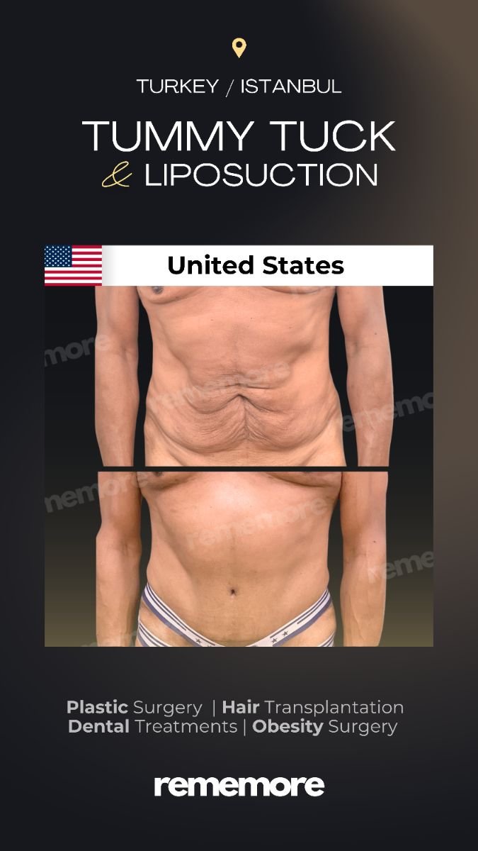 Resultados de abdominoplastia y liposucción antes y después en Memorial Şişli Hospital, Turquía