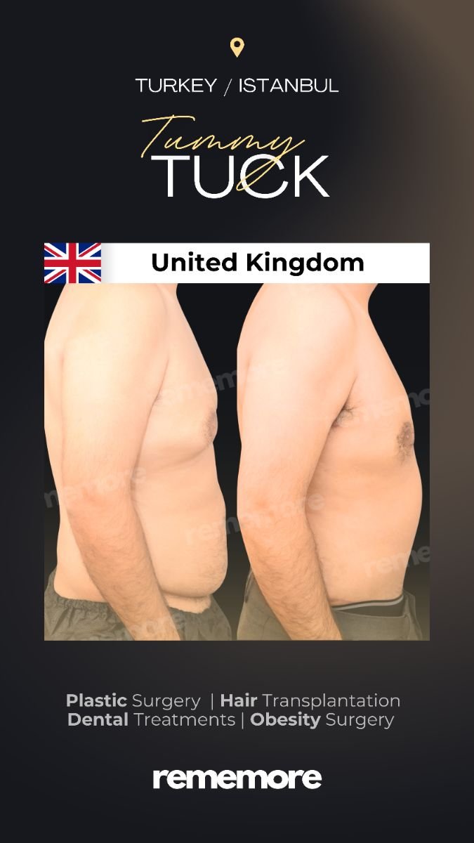 Resultados de abdominoplastia antes y después en Memorial Şişli Hospital, contorno visible