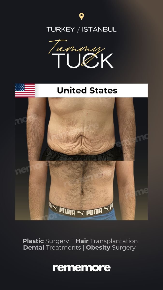 Resultados de abdominoplastia antes y después en Memorial Şişli Hospital, contorno visible