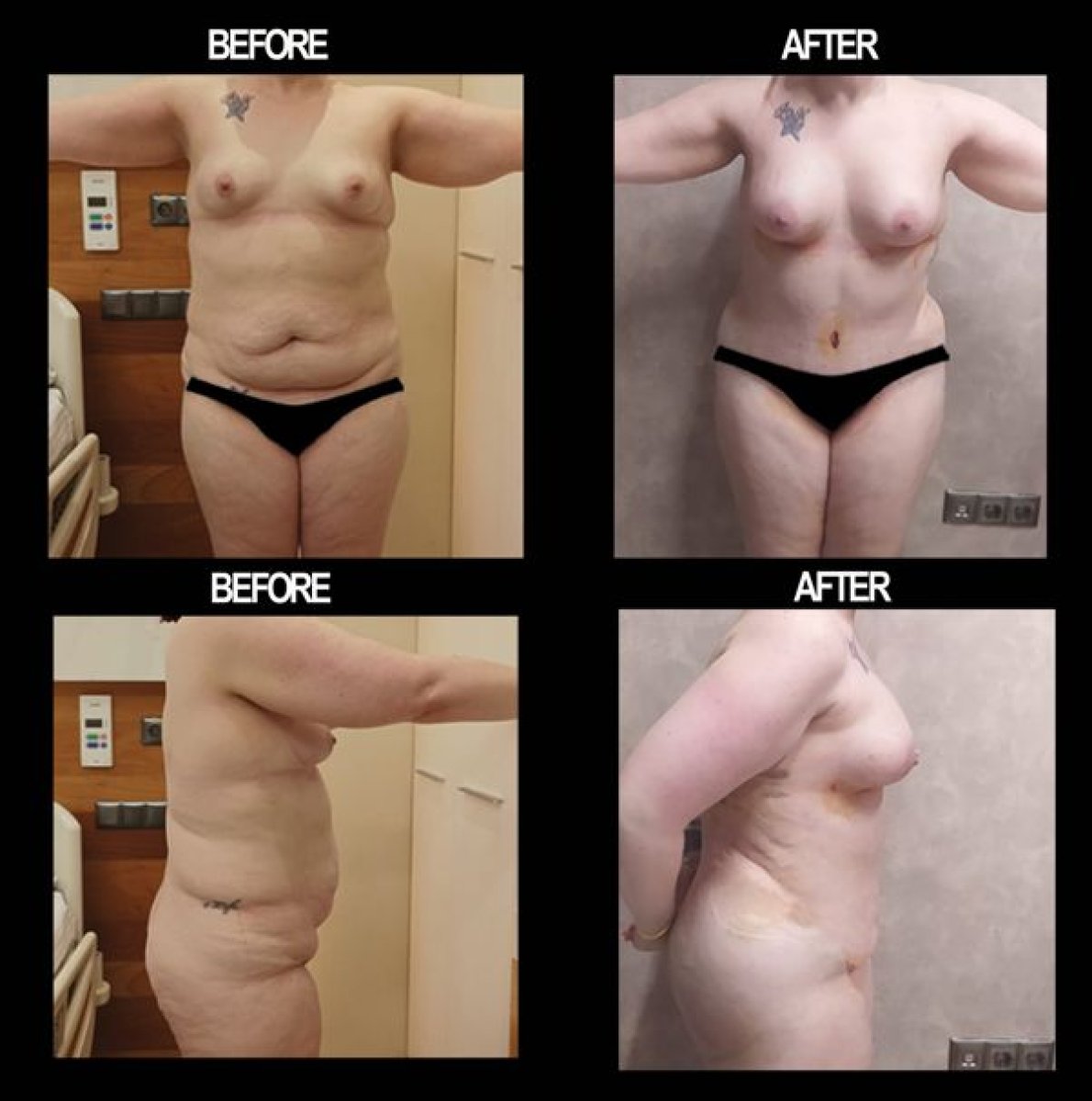 Before and after liposuction results at Atlas University Hospital – visible body contouring