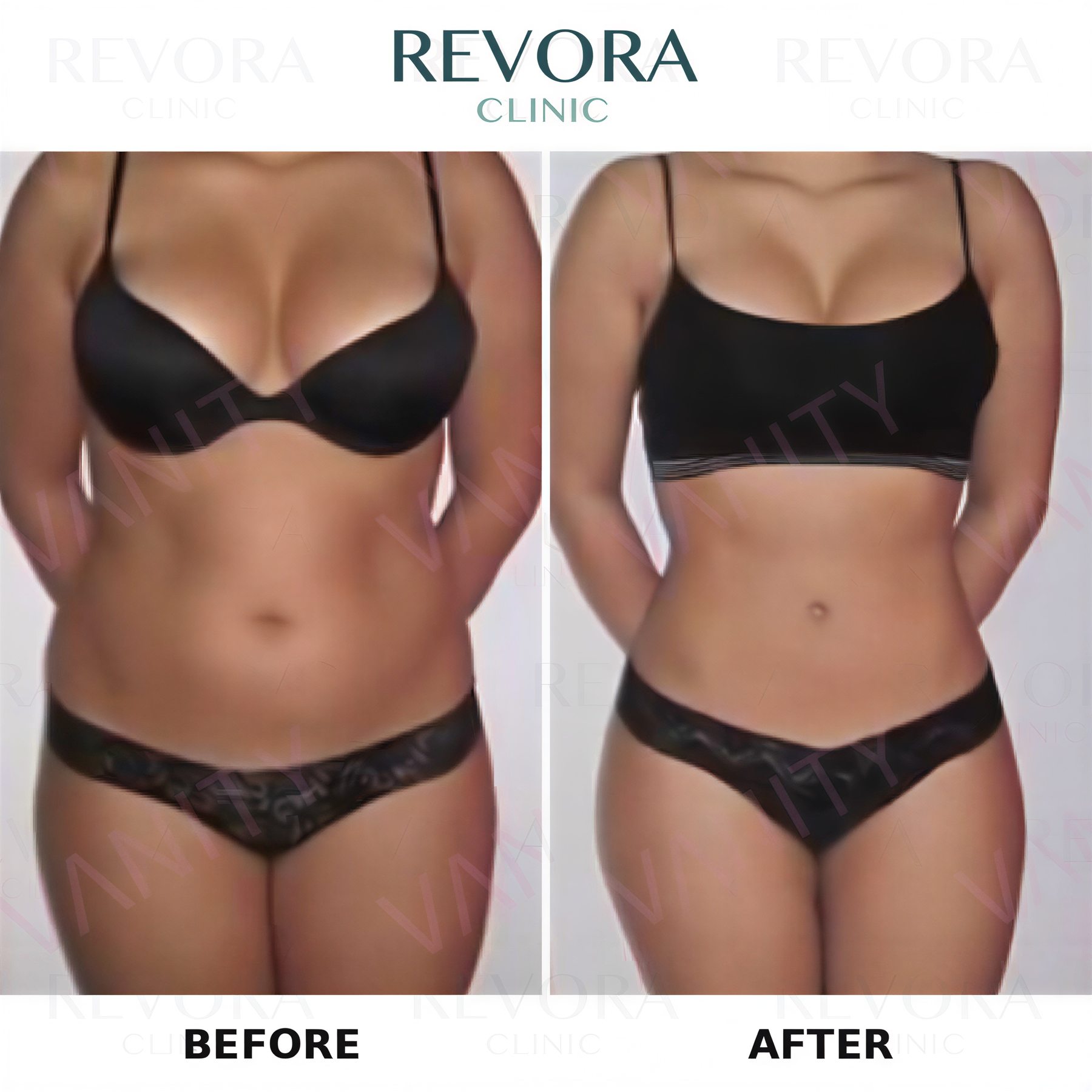 Resultados antes y después de liposucción Vaser en Vanity Cosmetic Surgery Center, contorno corporal