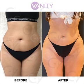 Standard One Area Vaser liposuction in Vanity Istanbul - photo 4