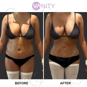 Standard One Area Vaser liposuction in Vanity Istanbul - photo 3