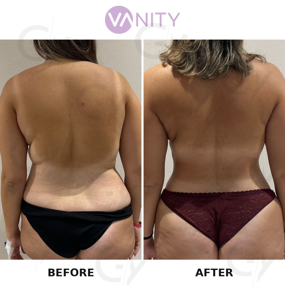 Before and after Vaser liposuction results at Vanity Cosmetic Surgery Center, improved back contour