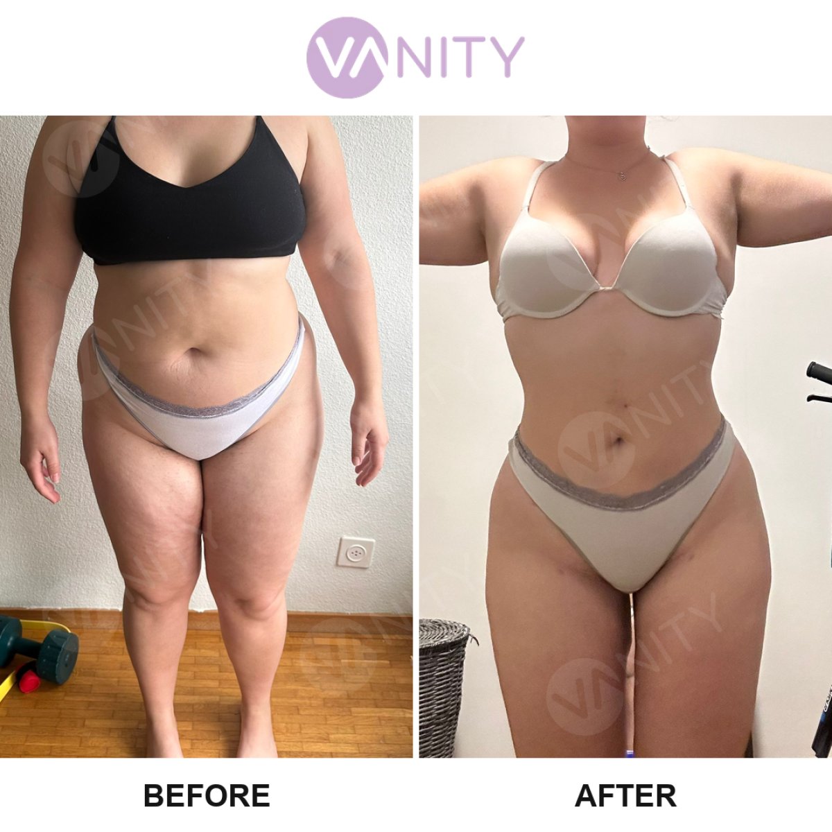 Résultats avant et après liposuccion Vaser au Vanity Cosmetic Surgery Center, remodelage du corps