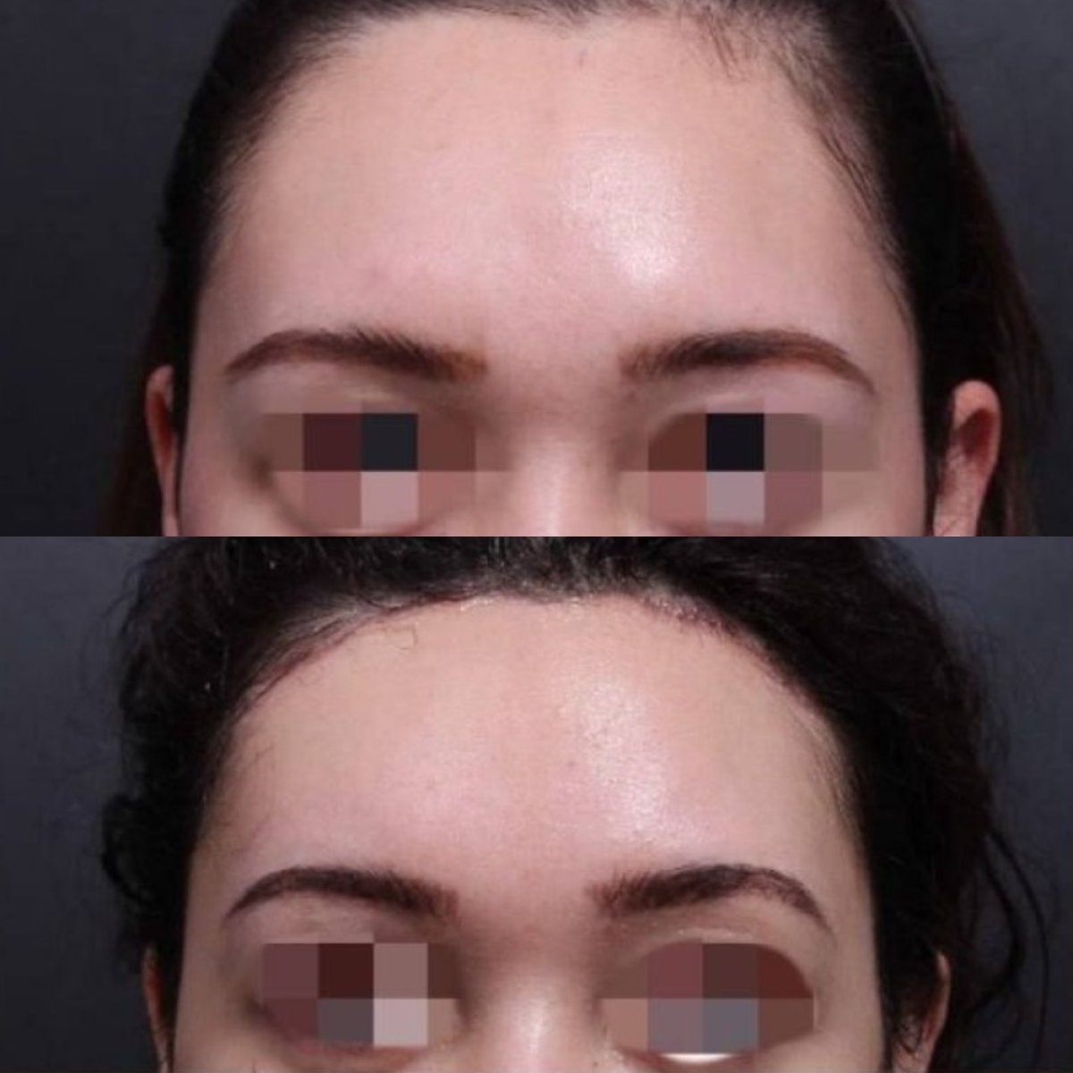 Resultados antes y después de lifting de cejas en VG Plastic Surgery, elevación visible