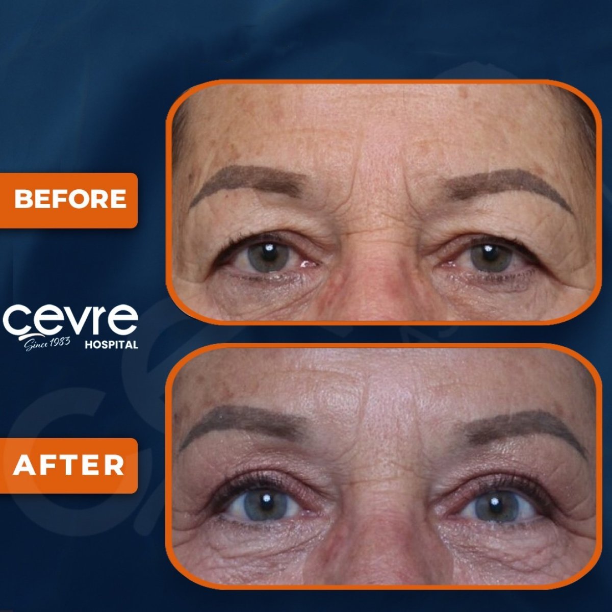 Before and after upper and lower eyelid surgery results at Adem and Havva Medical Center