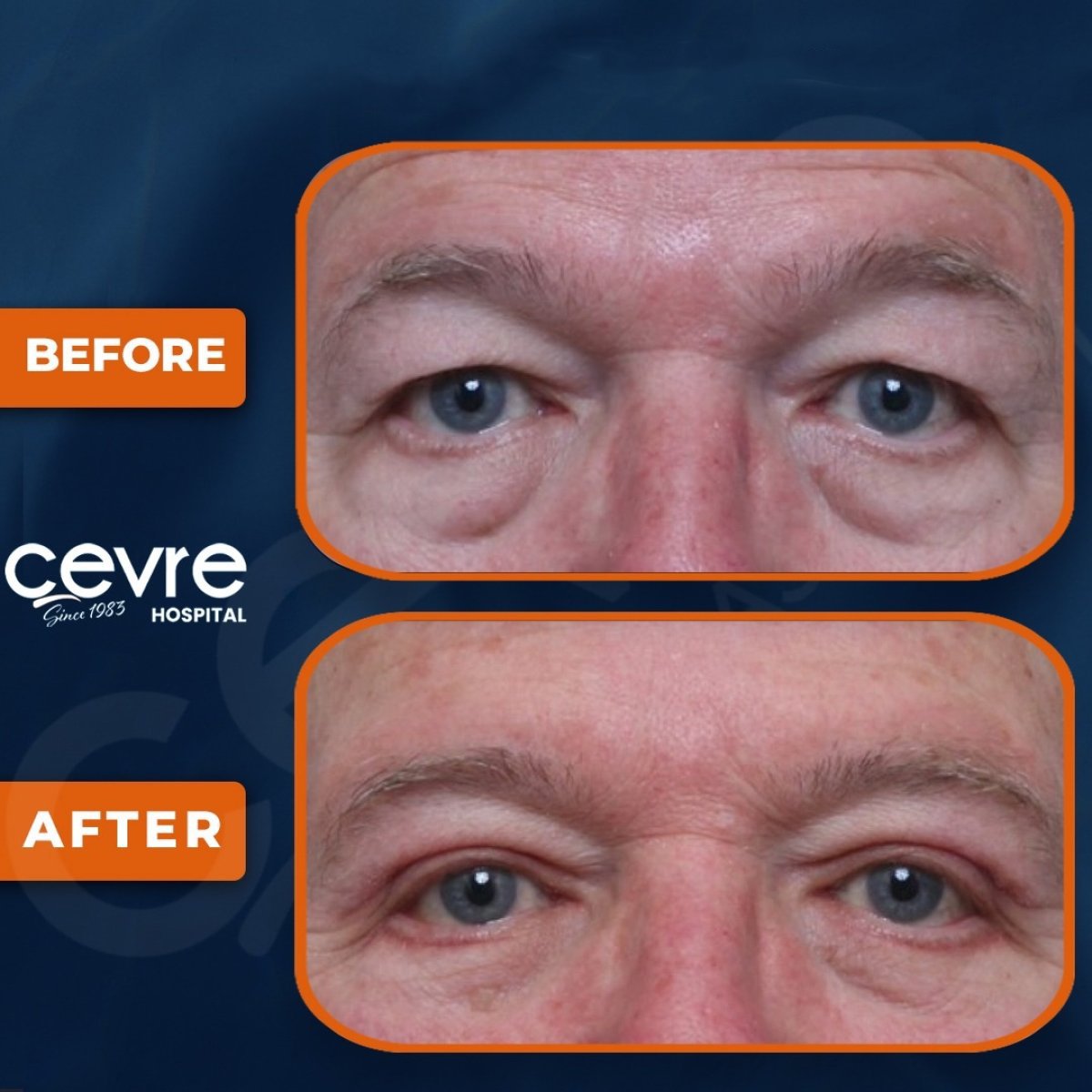 Before and after upper and lower eyelid surgery results at Adem and Havva Medical Center