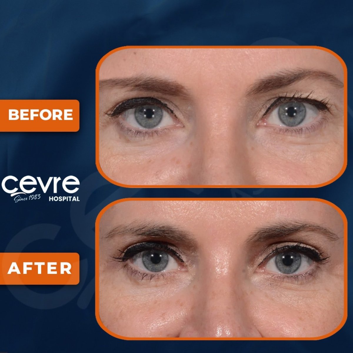 Upper and lower eyelid surgery results at Adem and Havva Medical Center, rejuvenated eye area
