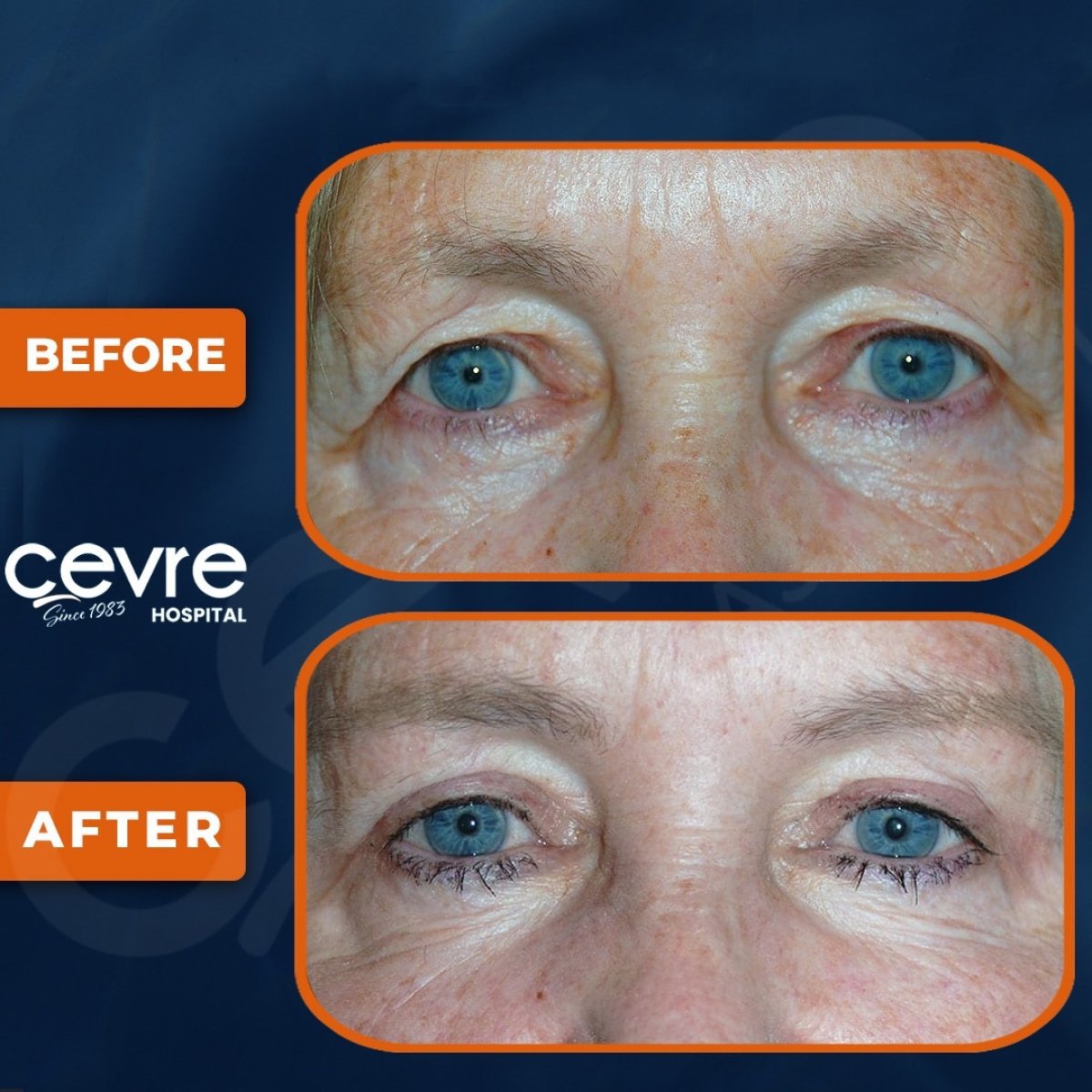 Before and after upper and lower eyelid surgery results at Adem and Havva Medical Center