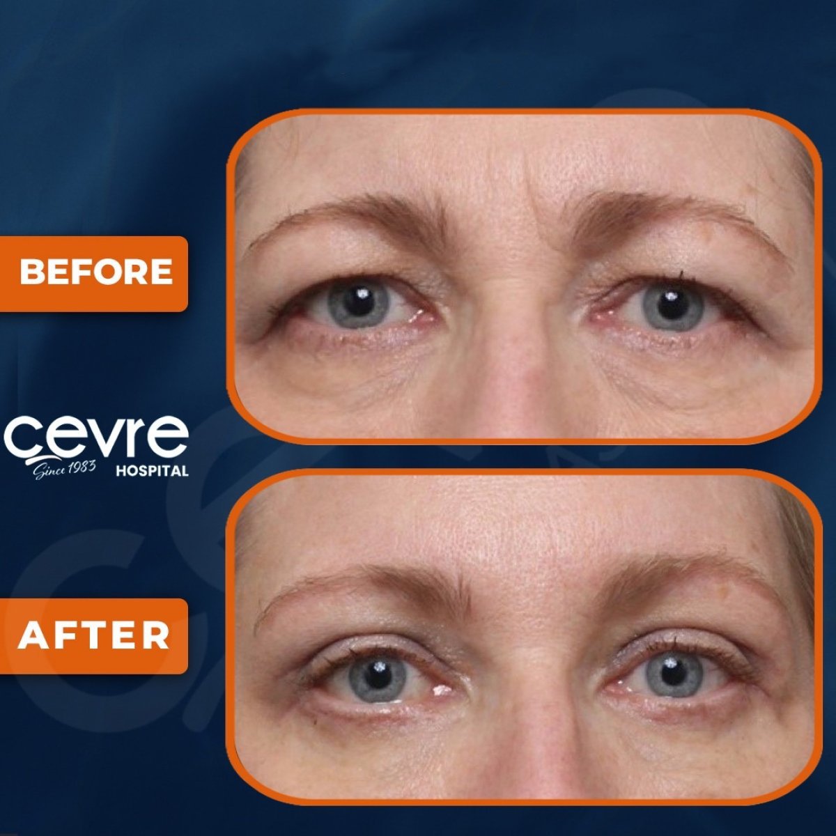 Upper and lower eyelid surgery results at Adem and Havva Medical Center, rejuvenated eye area