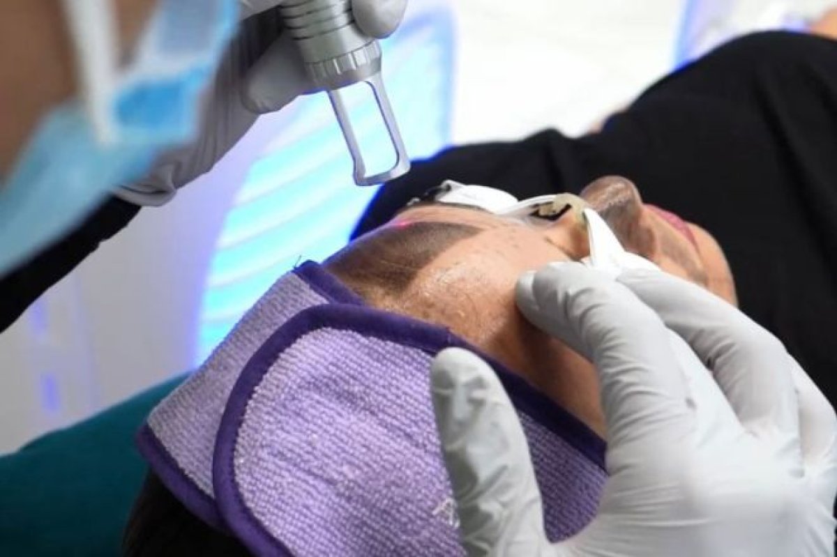 Rejuvenecimiento facial con terapia de células madre en Aesthetics Quantum Biohack Clinic resultado