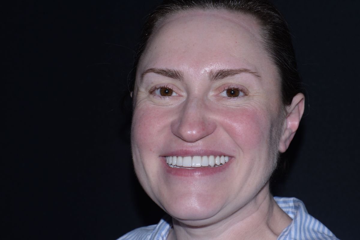 Resultado de implante dental en YeahSmile – sonrisa restaurada con dientes naturales
