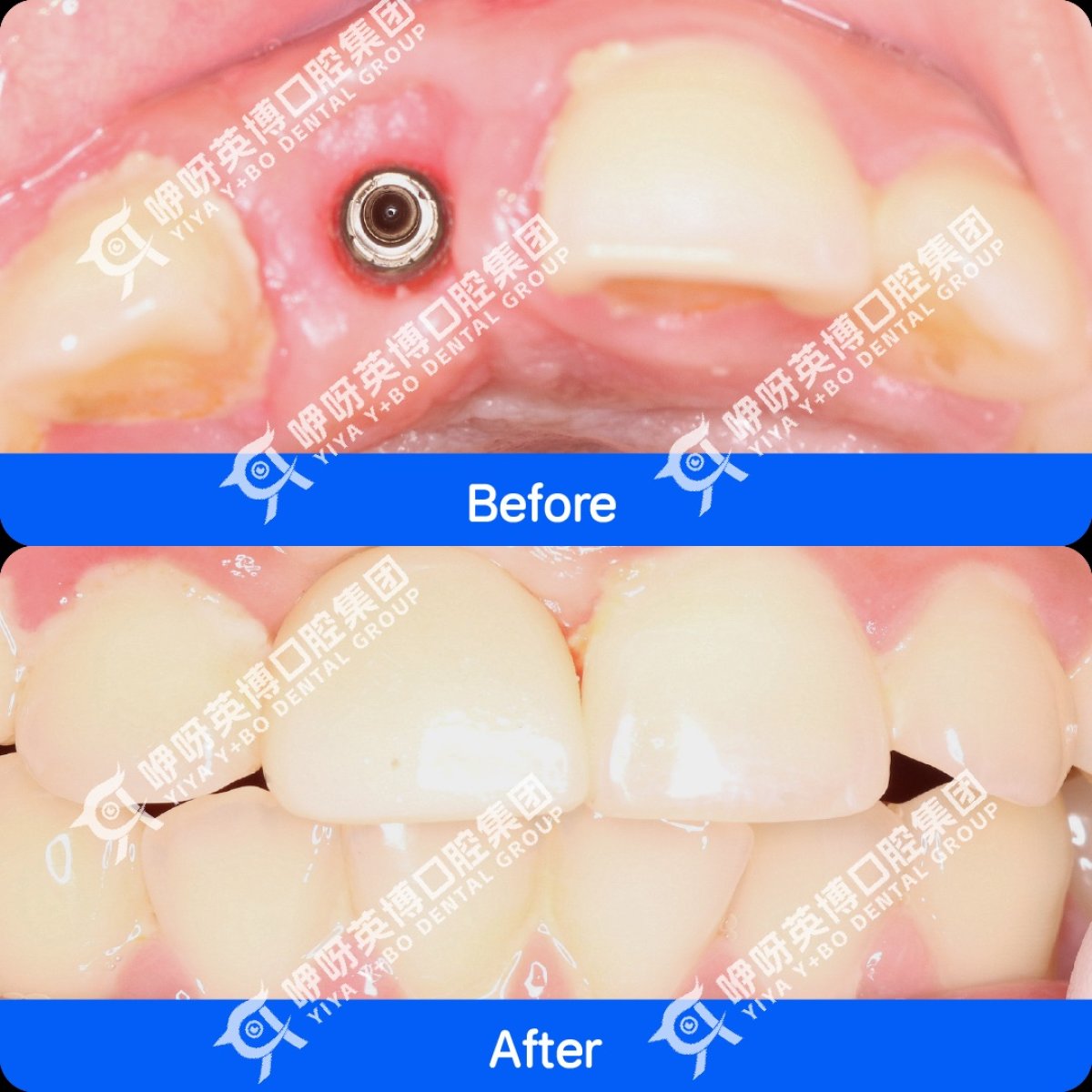نتيجة زراعة الأسنان قبل وبعد في عيادة Shanghai Y+bo Dental Clinic، ترميم السن الأمامي