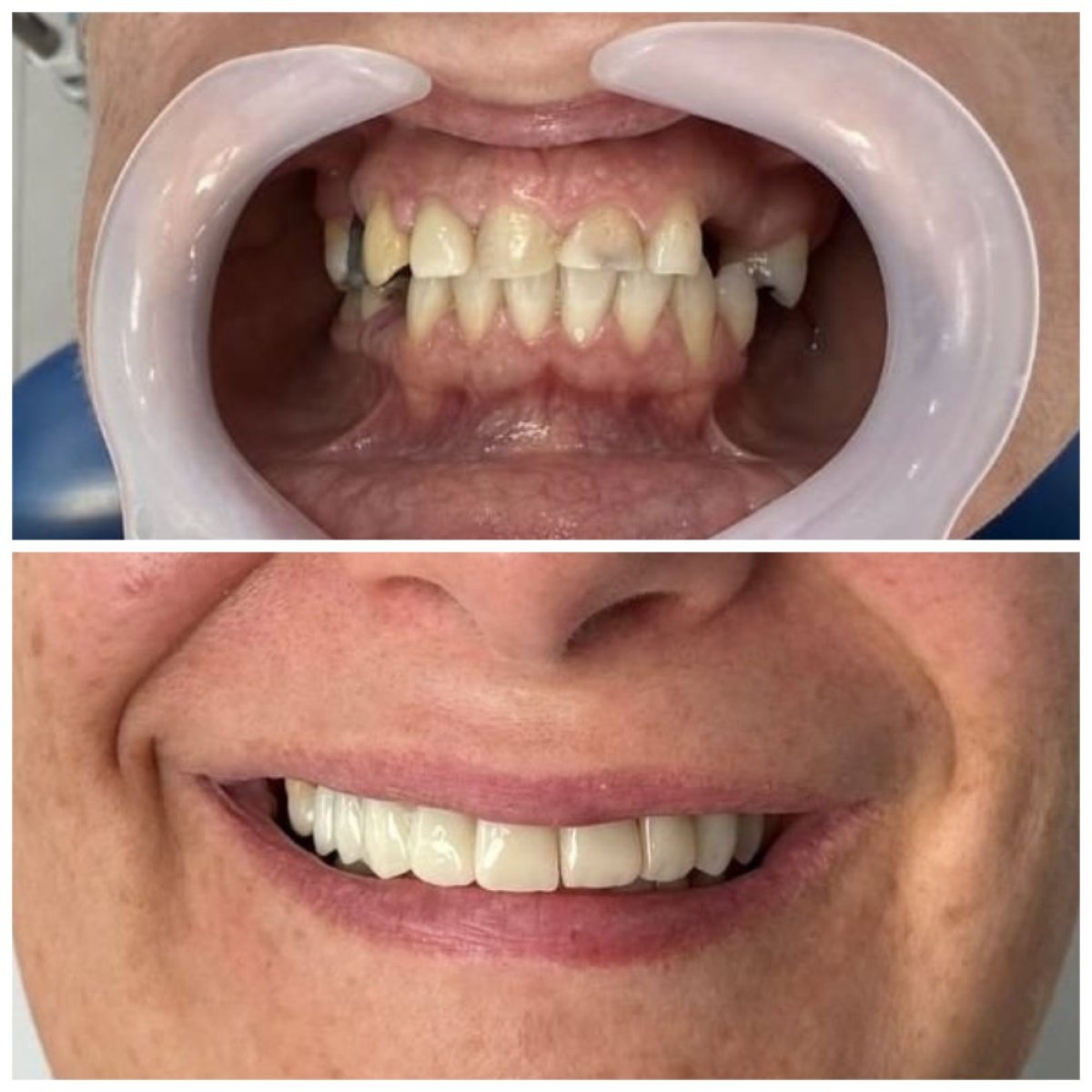 نتيجة قبل وبعد زراعة الأسنان All-on-6 في Santa Caterina Clinic Dental & Aesthetic Medicine