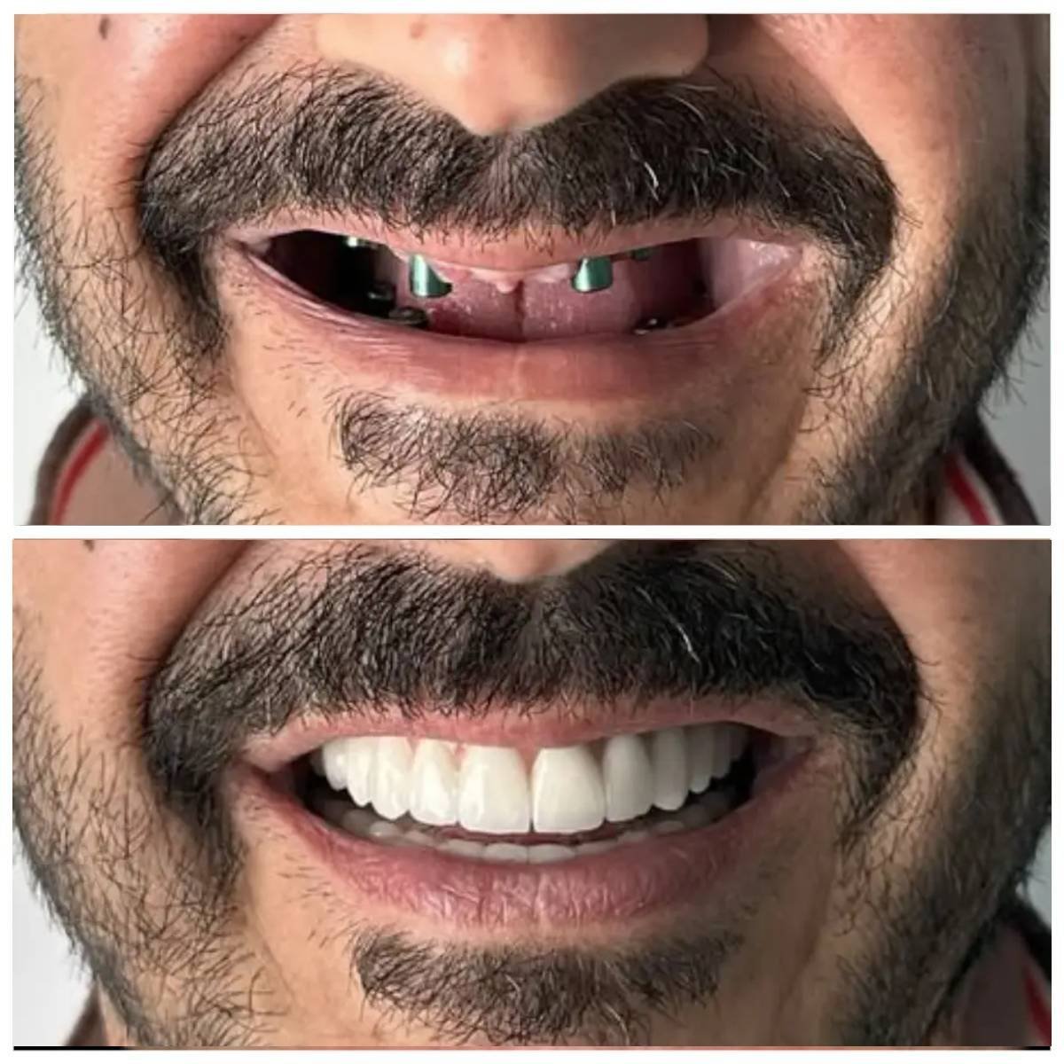 نتيجة قبل وبعد زراعة الأسنان All-on-6 في Santa Caterina Clinic Dental & Aesthetic Medicine
