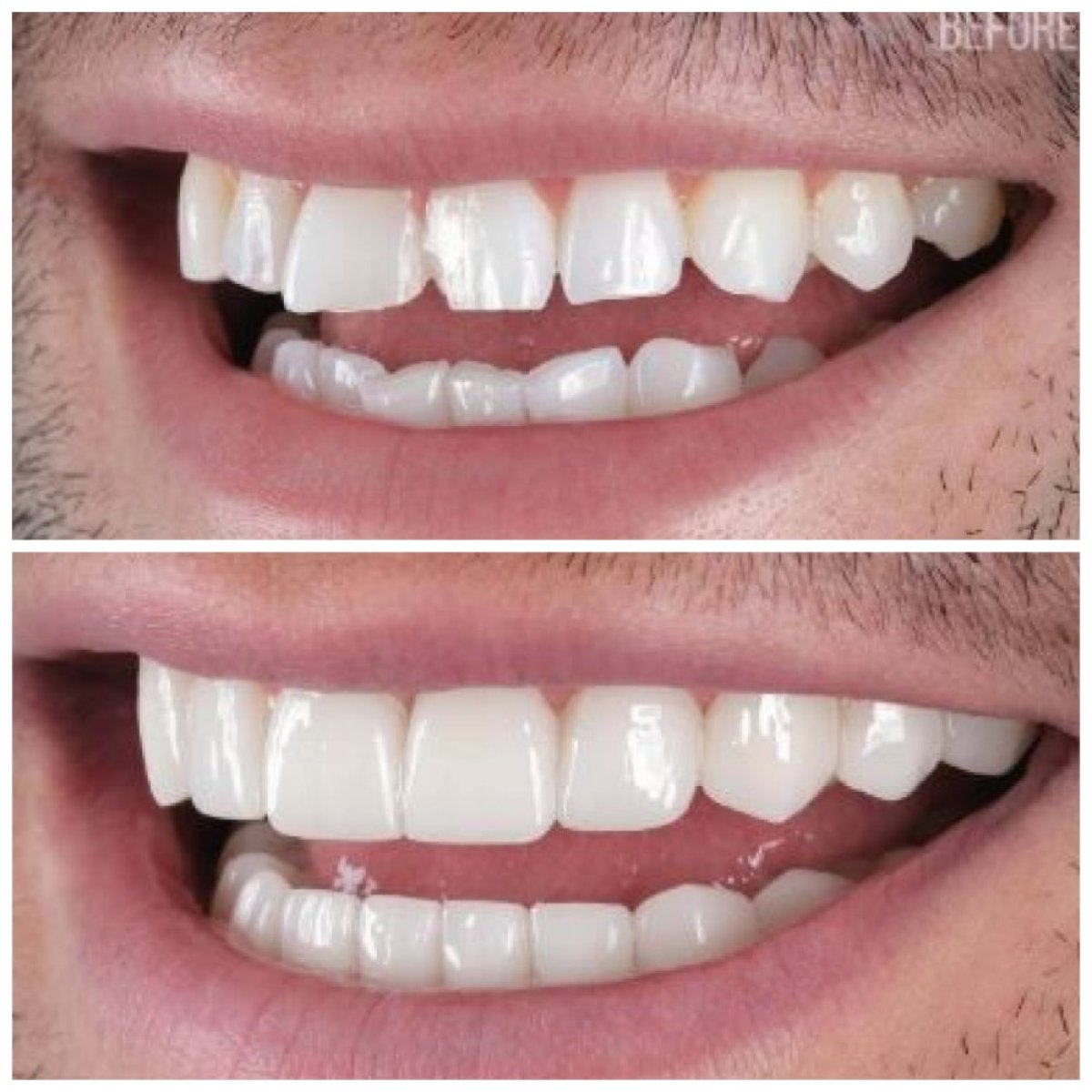 Resultados antes y después de carillas dentales en Santa Caterina Clinic Dental & Aesthetic Medicine