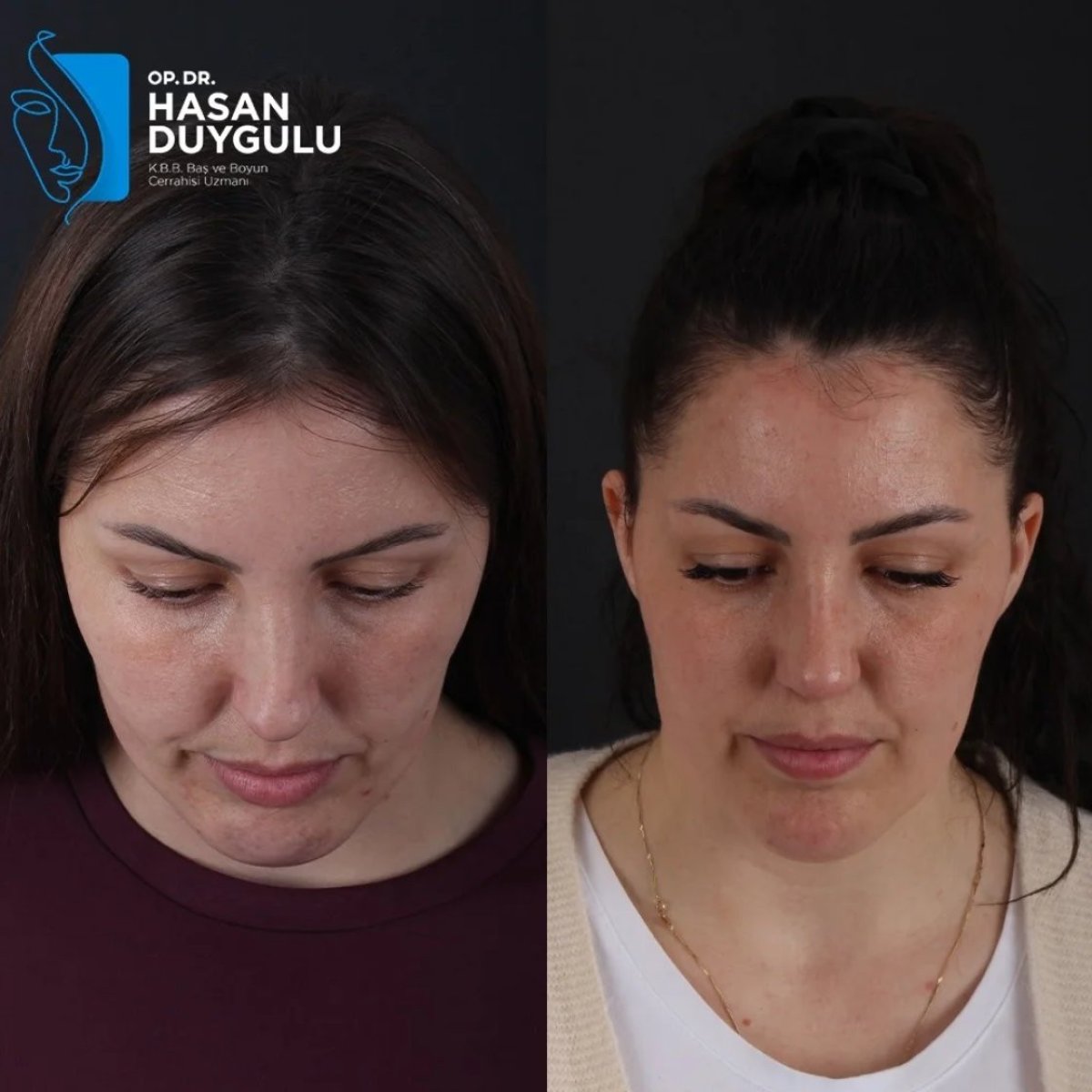 Resultados de rinoplastia antes y después en Dr. Hasan Duygulu Private Practice, nariz mejorada