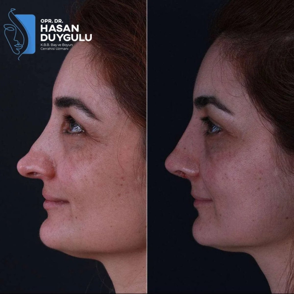Before and after rhinoplasty results at Dr. Hasan Duygulu Private Practice, improved nose profile
