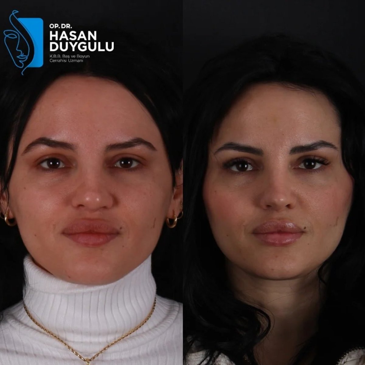 Vorher-nachher-Ergebnisse der Nasenkorrektur bei Dr. Hasan Duygulu Private Practice