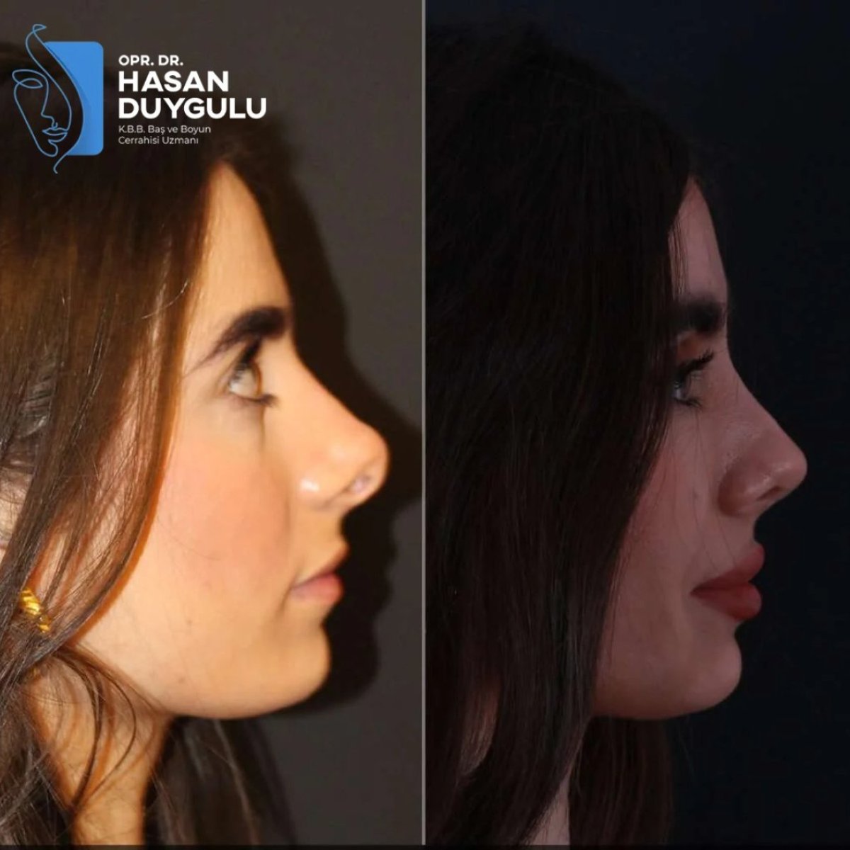 Resultados de rinoplastia antes y después en Dr. Hasan Duygulu Private Practice, remodelación nasal