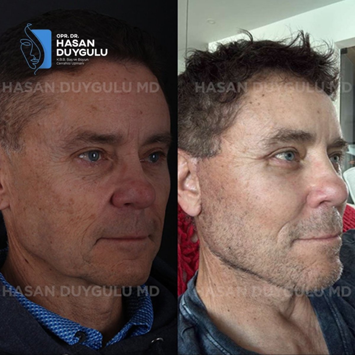 Resultados de rinoplastia antes y después en Dr. Hasan Duygulu, forma de nariz mejorada
